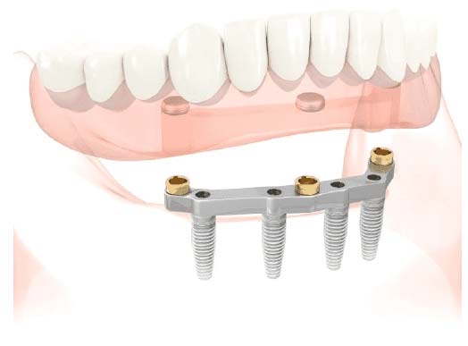 Impianti dentali e protesi mobili per denti - Centro Odontoiatrico Atena, Brindisi